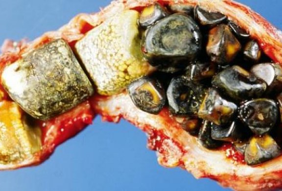 حصوات المرارة وعلاجها في صفاقس عاصمة الجنوب